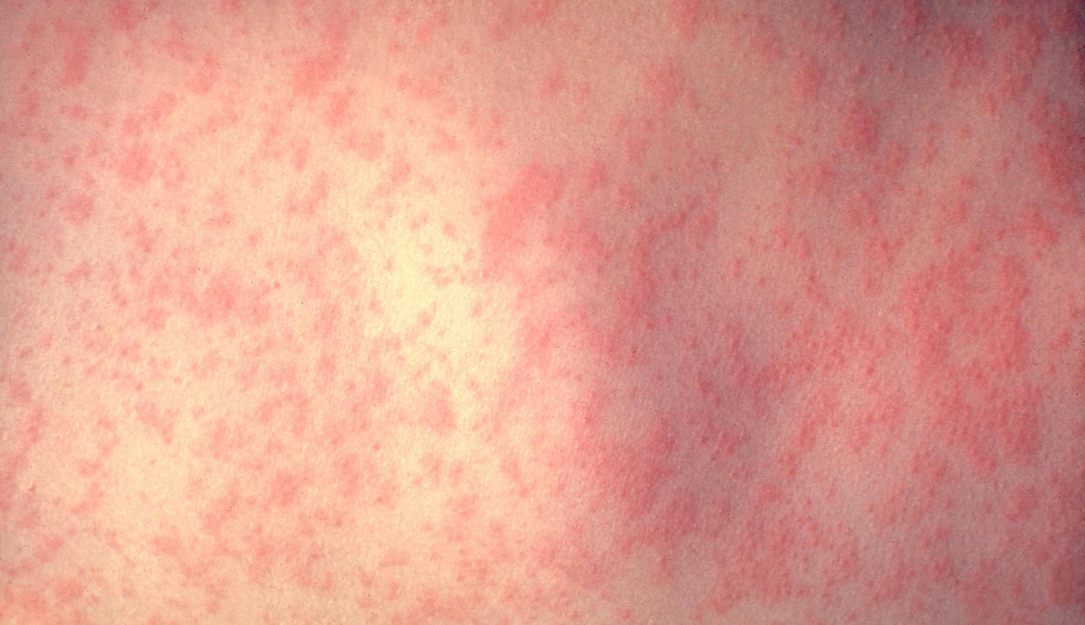 A rash forms on a person with measles three to five days after they contract the virus. (Centers for Disease Control and Prevention)